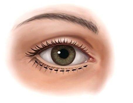 У пациентки остались шрамы и рубцы: возбуждено уголовное дело в отношении частного косметолога в Крыму