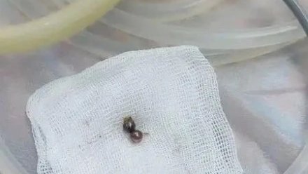 Севастопольские хирурги спасли ребёнка, который проглотил магнитные шарики