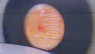 В Симферополе можно пройти бесплатное обследование на меланому 