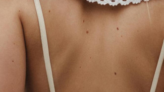 Симферопольцы могут пройти бесплатное обследование на меланому
