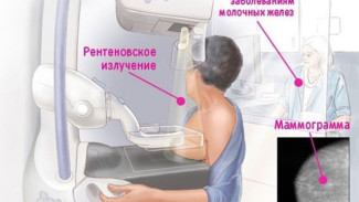 В Ялте и поселках южного берега Крыма продолжит работу выездной маммограф