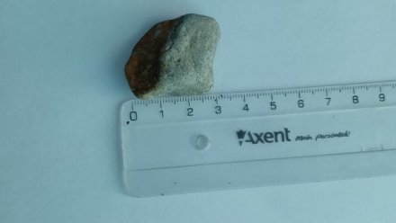 Крымские врачи достали камень из пищевода ребенка