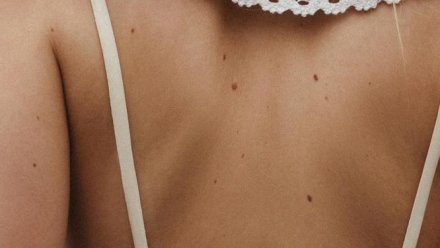 Симферопольцы могут пройти бесплатное обследование на меланому